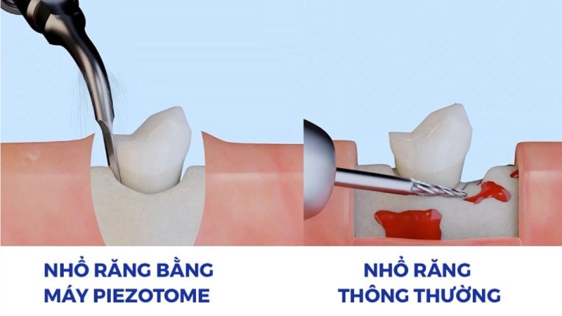 Răng số 4 là răng gì? Vị trí, chức năng và những lưu ý quan trọng 6 Nhổ răng không đau với máy Piezotome tại nha khoa Sài Gòn Phong Phú