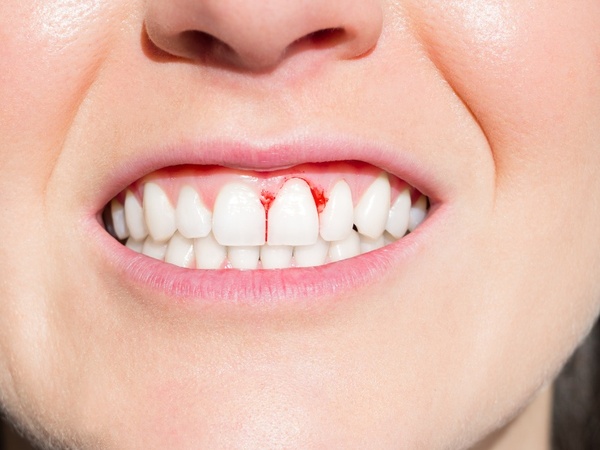 Nguyên nhân răng sứ bị chảy máu và cách xử lý an toàn 1 Bọc răng sứ bị chảy máu là dấu hiệu của bệnh lý gì?