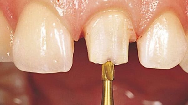 Nguyên nhân răng sứ bị chảy máu và cách xử lý an toàn 2 Kỹ thuật mài cùi răng không chính xác có thể dẫn đến việc xâm phạm khoảng sinh học