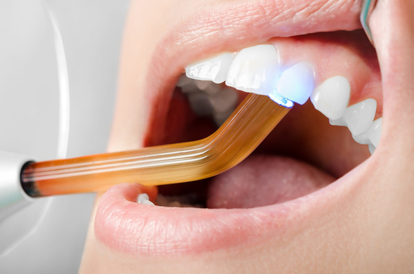 Nguyên nhân răng sứ bị chảy máu và cách xử lý an toàn 3 Sót xi măng nha khoa dưới nướu khi gắn răng