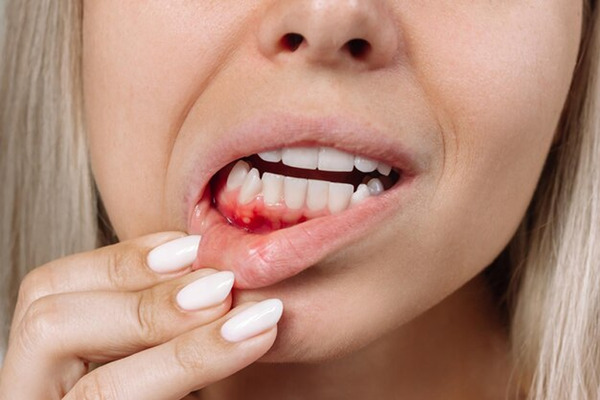 Nguyên nhân răng sứ bị chảy máu và cách xử lý an toàn 4 Phản ứng dị ứng với dòng răng sứ kim loại