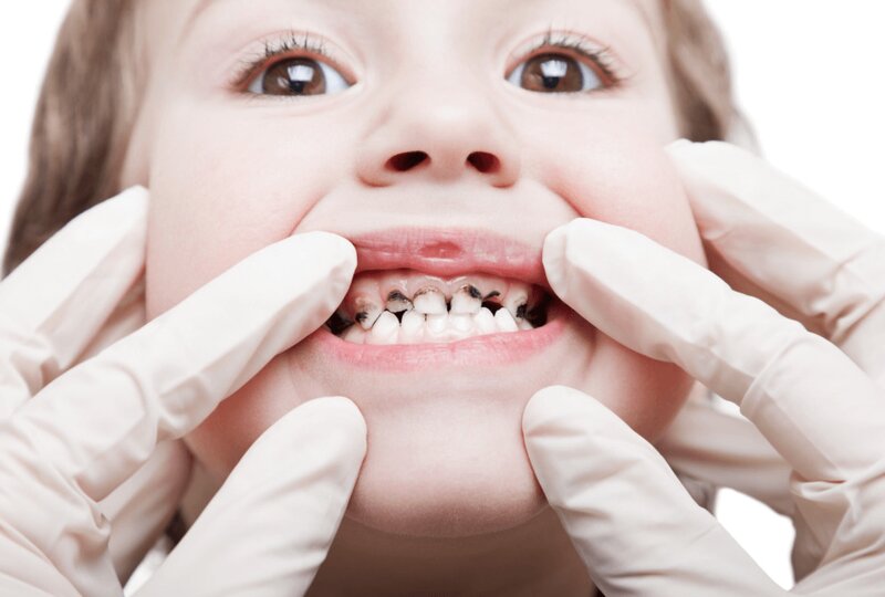 Trẻ em dưới 18 tuổi có bọc răng sứ được không? Trẻ em dưới 18 tuổi có bọc răng sứ được không?