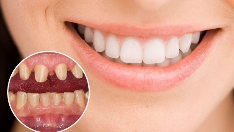 Ưu và nhược điểm của răng sứ Ceramco Ưu và nhược điểm của răng sứ Ceramco