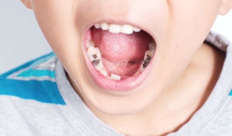 Trám răng phục hồi đối với răng vĩnh viễn của trẻ Trám răng phục hồi đối với răng vĩnh viễn của trẻ