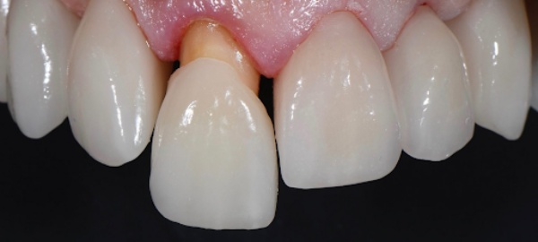 Răng sứ bị rớt ra có gắn lại được không? Răng sứ bị rớt ra có gắn lại được không?