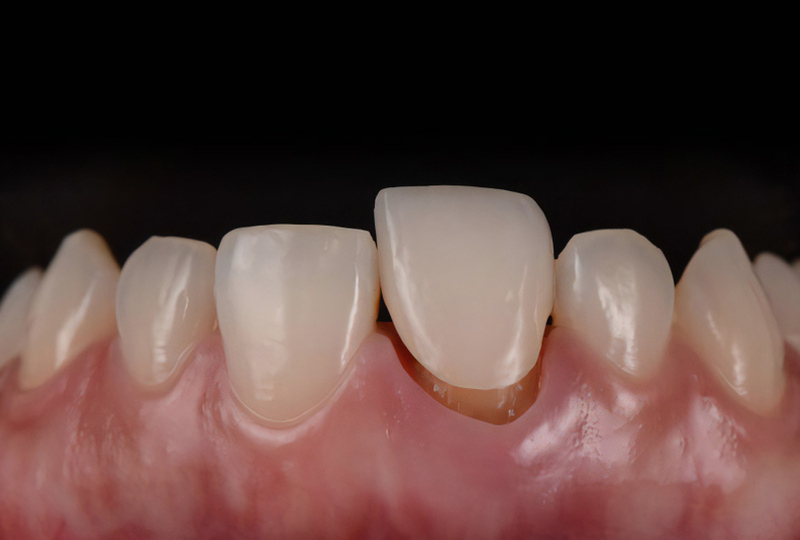 Hướng dẫn cách xử lý khẩn cấp khi răng sứ bị rớt ra tại nhà Hướng dẫn cách xử lý khẩn cấp khi răng sứ bị rớt ra tại nhà