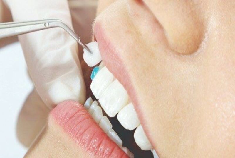 Điều trị răng sứ bị rớt an toàn tại Nha khoa Sài Gòn Phong Phú Điều trị răng sứ bị rớt an toàn tại Nha khoa Sài Gòn Phong Phú