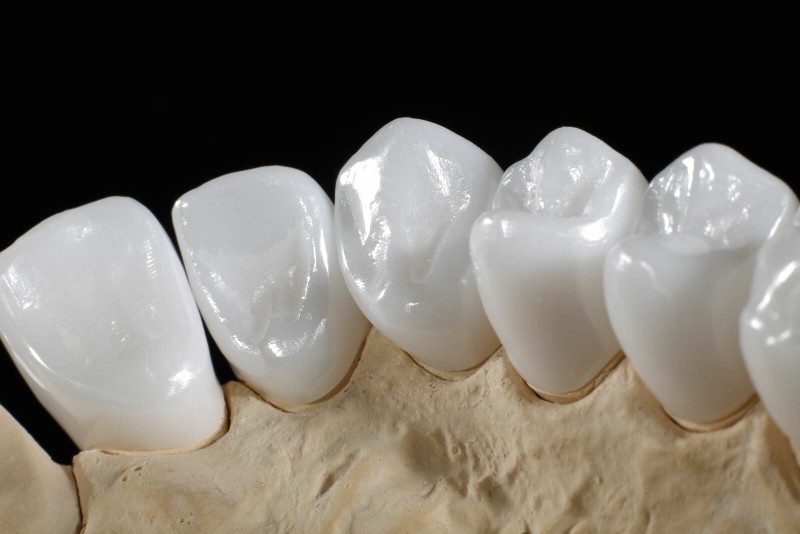 Răng sứ Bio Esthetic là gì? Răng sứ Bio Esthetic là gì?