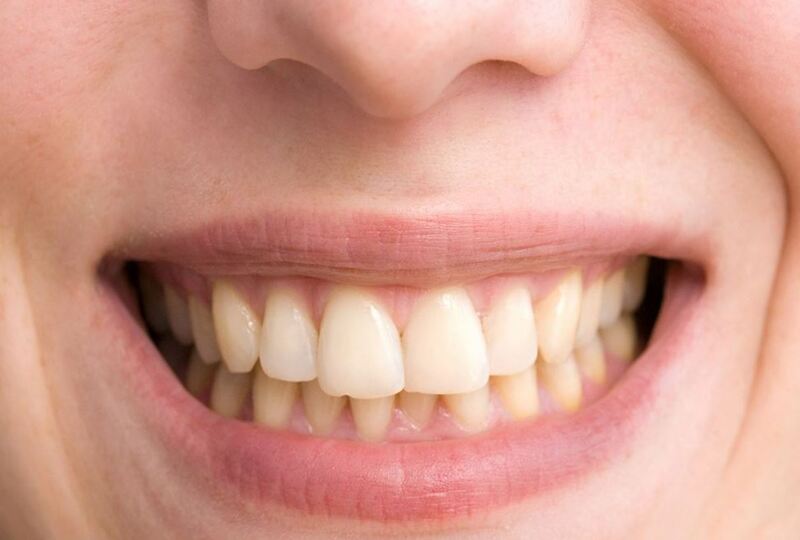 Răng sứ có bị ố vàng, xuống màu theo thời gian không? Răng sứ có bị ố vàng không? Răng sứ có bị ố vàng, xuống màu theo thời gian không?