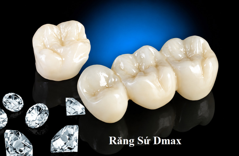 Răng sứ Dmax có tốt không? Răng sứ Dmax có tốt không?