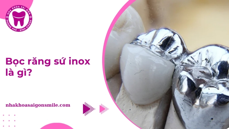 răng sứ inox