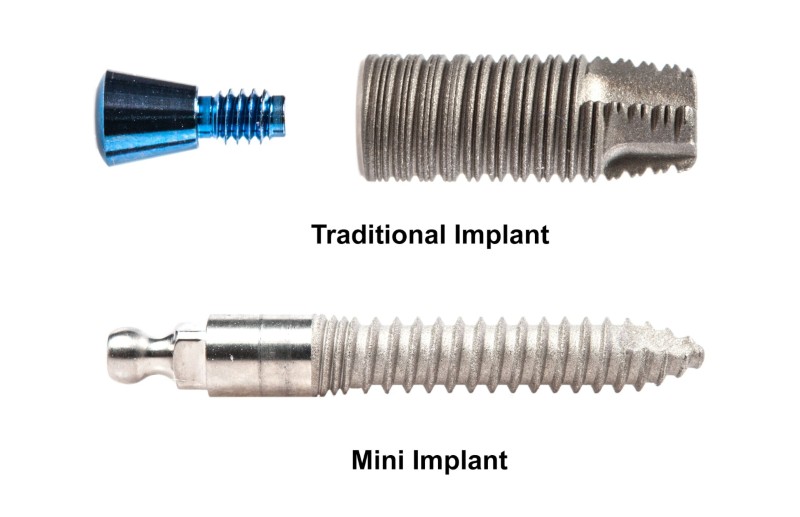 Mini implant là gì? Mini implant là gì?