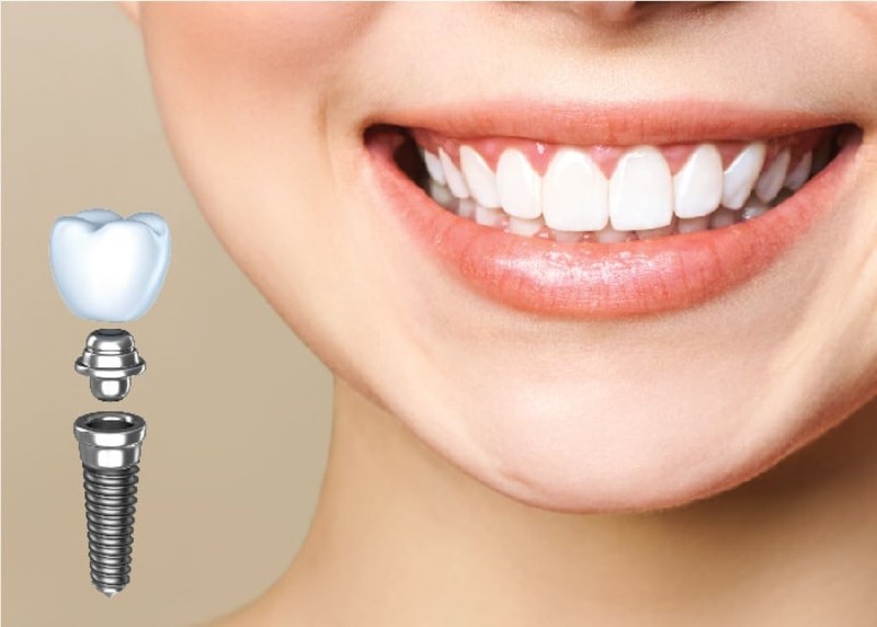 Một ca trồng răng implant tiêu chuẩn thường kéo dài từ 3 đến 6 tháng Một ca trồng răng implant tiêu chuẩn thường kéo dài từ 3 đến 6 tháng