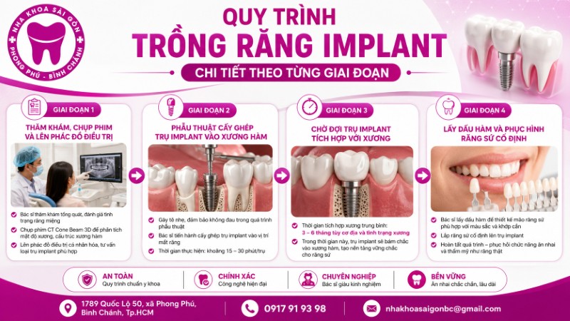 Trồng răng implant mất bao lâu? 4 giai đoạn chính trong quy trình trồng răng implant Trồng răng implant mất bao lâu? 4 giai đoạn chính trong quy trình trồng răng implant